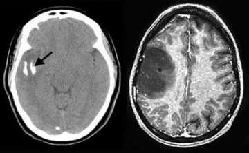 Oligodendroglioma